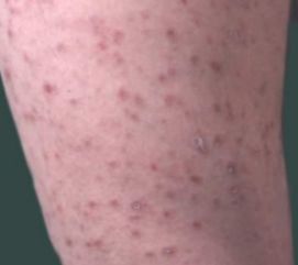 孕妇牛皮癣的科学管理与治疗策略