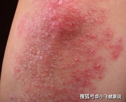 牛皮癣会传染么 专家说 对于银屑病,你们的 误解 实在太深