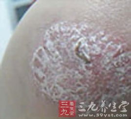 牛皮癣患者不能吃哪些食物