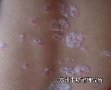 哪些因素会导致银宵病