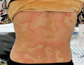 银屑病（牛皮癣）的治疗方法及管理策略