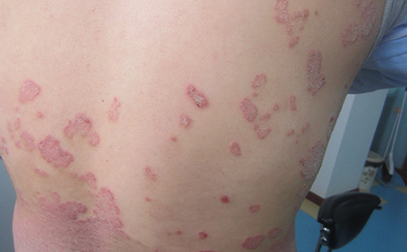 银屑病早期症状识别与预防