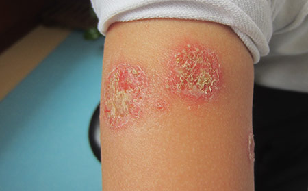 脓疱性牛皮癣概述 症状、类型与治疗方法详解