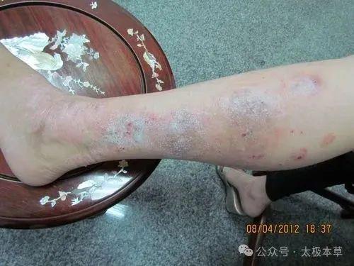 四大中医名家治疗牛皮癣的经验名方