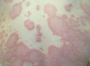 牛皮癣的治疗方法与注意事项