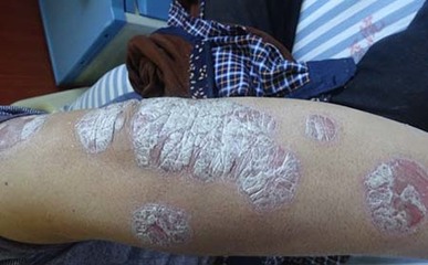 牛皮癣患者如何有效避免亚健康？