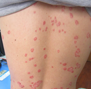 牛皮癣治疗中维生素C的作用与机制