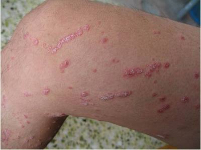 牛皮癣瘙痒反复不愈，如何科学应对与管理