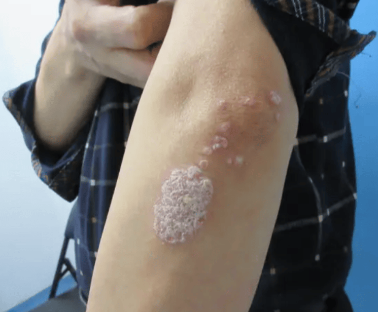 牛皮癣康复新篇 打破困局，解锁无痒人生