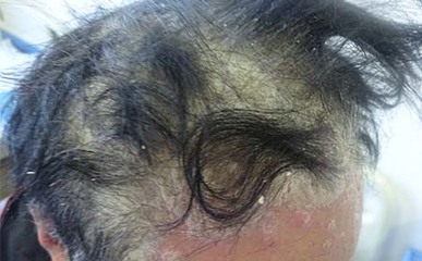 头部银屑病发生的主要原因探析