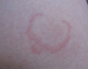 少年脓疱型牛皮癣的中医病因探析