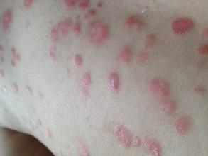 男性银屑病（牛皮癣）常用外用药全解析