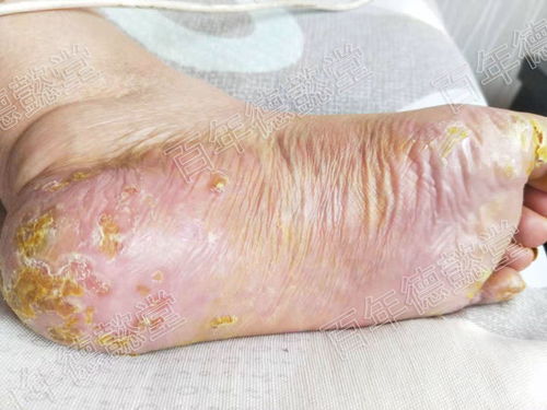 掌跖脓疱病与牛皮癣 异同解析