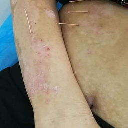 一根火针点燃三十年牛皮癣患者的希望